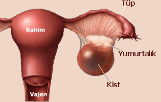 yumurtalik_kanseri