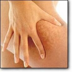 ender sarac selulit tedavi