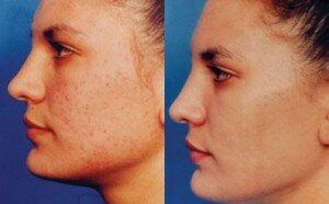 kimyasal peeling nedir
